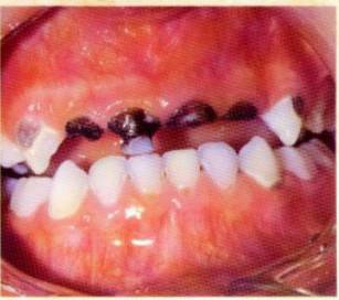 乳牙蛀牙嚴重，但係牙唔痛，需要“殺神經”嗎？