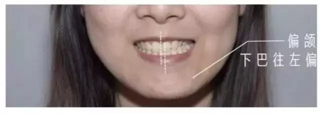 牙齒畸形，凸嘴該如何矯正？