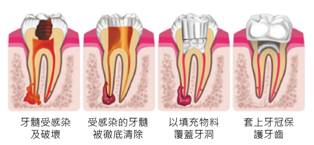 牙髓/根管治療(杜牙根)